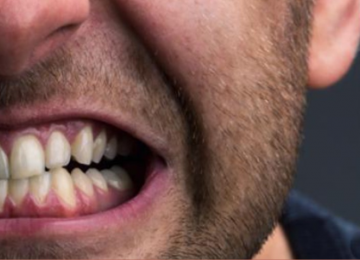O AUMENTO DO BRUXISMO ENTRE JOVENS: UM ALERTA PARA A SAÚDE MENTAL E FÍSICA