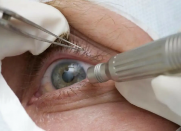 Cirurgia que muda cor dos olhos pode causar cegueira e não é estética segura, alerta conselho