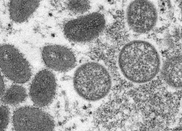 Com oito casos suspeitos no Brasil, São Paulo confirma 1º caso de varíola dos macacos no país