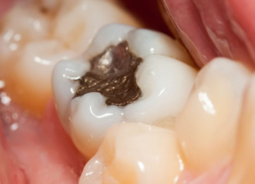 Brasil vai eliminar uso de restaurações prateadas até 2030