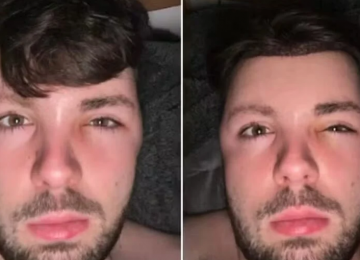 Jovem ignora proibição de sexo após transplante capilar e acorda com rosto deformado