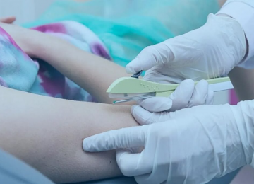 Implanon chega ao SUS em outubro e amplia opções de contracepção para mulheres