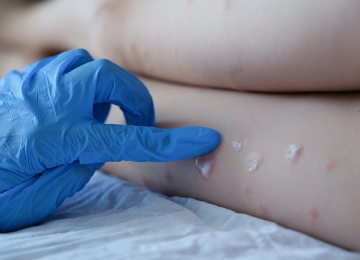 Goiás tem os primeiros casos confirmados de varíola