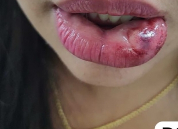Mulher tem a boca mordida e celular quebrado por namorado após briga, em Santa Helena
