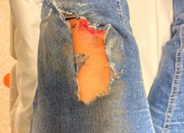 Motociclista fica ferida após perder controle e bater em canteiro no setor Pauzanes