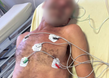 Morador de rua é agredido com pedra na cabeça e tórax