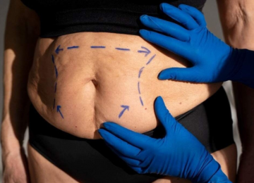 Cirurgia bariátrica poderá ser feita a partir dos 14 anos e com IMC menor