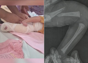 Laboratório nega responsabilidade por fratura em bebê durante teste do pezinho, em Aparecida