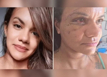 Mulher agredida com 61 socos mostra como está seu rosto após cirurgia