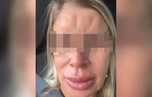 Choque Estético: Mulher denuncia deformações após procedimento com falsa esteticista em Goiânia