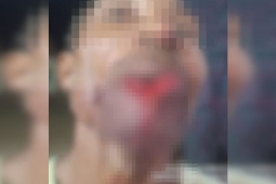 Adolescente arranca parte do lábio de homem em briga após bebedeira no Piauí