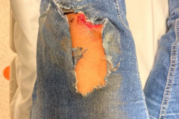 Motociclista fica ferida após perder controle e bater em canteiro no setor Pauzanes