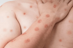 Brasil registra 55 casos de mpox em 2026 e mantém vigilância ativa da doença