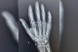 ROMU prende homem após agressão que deixou mulher com fratura na mão, em Rio Verde