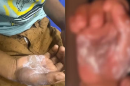 Mãe é presa suspeita de queimar filho de 7 anos com colher quente em Goiás