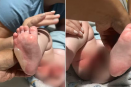 Bebê sofre queimaduras graves durante banho em berçário de Rio Verde