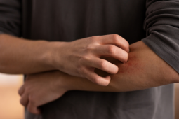 Após surto de coceira, colégio militar de Goiás investiga possível uso de pó de mico