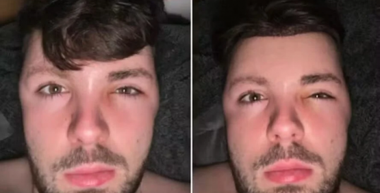 Jovem ignora proibição de sexo após transplante capilar e acorda com rosto deformado