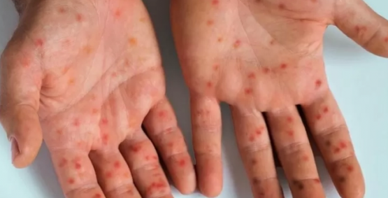 Goiás registra 15 notificações de Mpox em 2026, informa Secretaria de Saúde