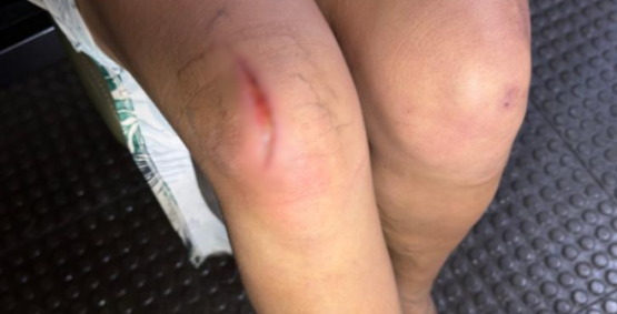 Mantida em cárcere privado, mulher se joga de moto em movimento para fugir do companheiro no Residencial Canaã