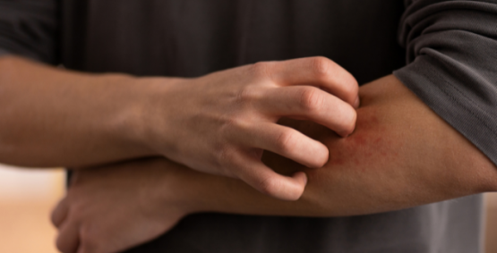 Após surto de coceira, colégio militar de Goiás investiga possível uso de pó de mico