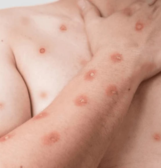 Brasil registra 55 casos de mpox em 2026 e mantém vigilância ativa da doença