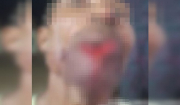 Adolescente arranca parte do lábio de homem em briga após bebedeira no Piauí