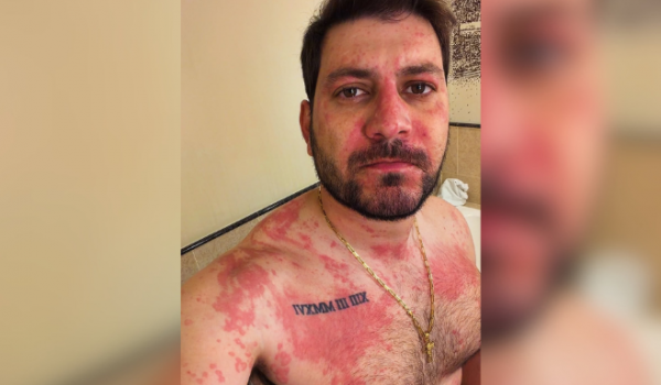 Ex-BBB Caio Afiune passa mal após reação alérgica e é levado ao hospital
