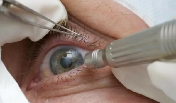 Cirurgia que muda cor dos olhos pode causar cegueira e não é estética segura, alerta conselho
