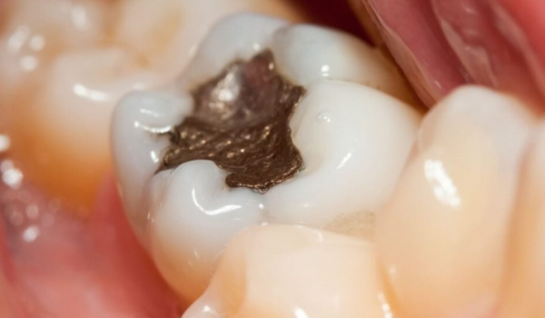 Brasil vai eliminar uso de restaurações prateadas até 2030