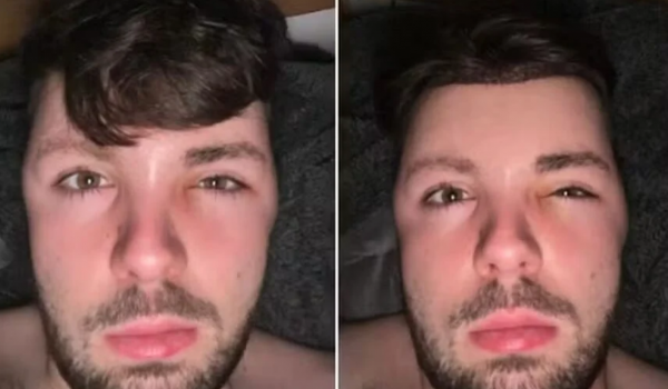 Jovem ignora proibição de sexo após transplante capilar e acorda com rosto deformado