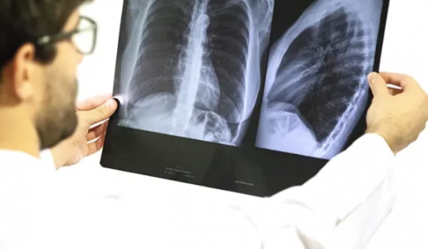 Goiás decreta emergência em saúde após alta de casos de síndrome respiratória grave