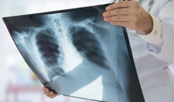 Medicamento brasileiro pode regenerar medula espinhal e desperta atenção mundial
