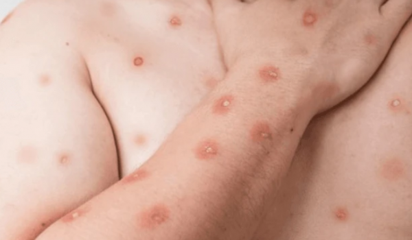 Brasil registra 55 casos de mpox em 2026 e mantém vigilância ativa da doença