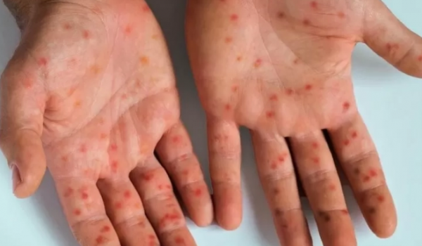 Goiás registra 15 notificações de Mpox em 2026, informa Secretaria de Saúde