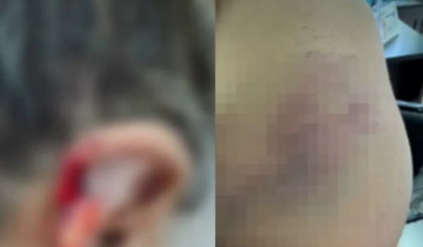 Neto é preso após arrancar pedaços da orelha da avó a mordidas e confessar que engoliu partes do corpo