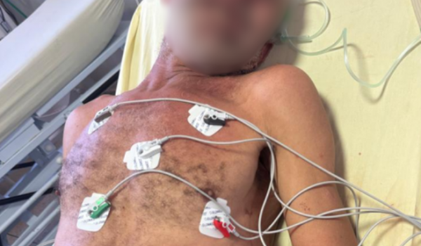 Morador de rua é agredido com pedra na cabeça e tórax