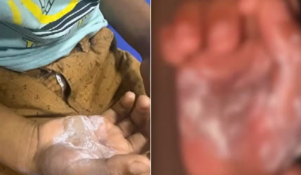 Mãe é presa suspeita de queimar filho de 7 anos com colher quente em Goiás