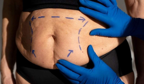 Cirurgia bariátrica poderá ser feita a partir dos 14 anos e com IMC menor