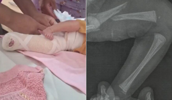 Laboratório nega responsabilidade por fratura em bebê durante teste do pezinho, em Aparecida