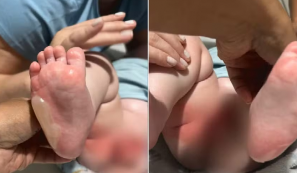 Bebê sofre queimaduras graves durante banho em berçário de Rio Verde