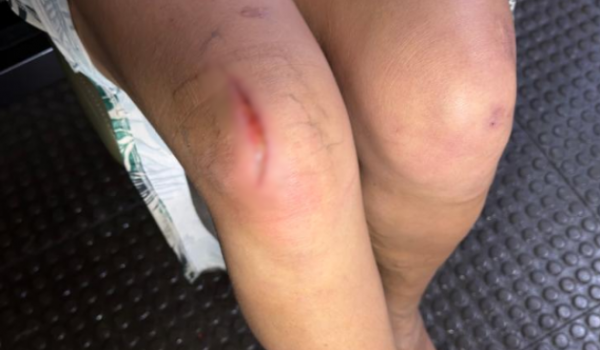 Mantida em cárcere privado, mulher se joga de moto em movimento para fugir do companheiro no Residencial Canaã