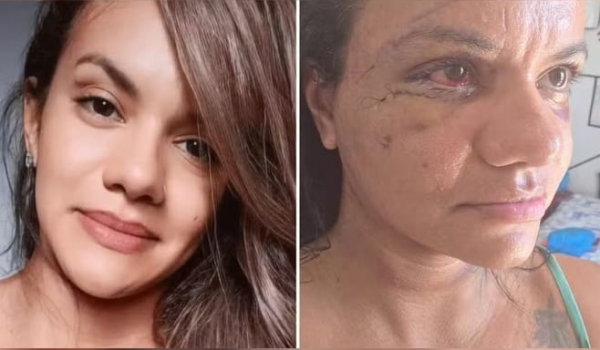 Mulher agredida com 61 socos mostra como está seu rosto após cirurgia