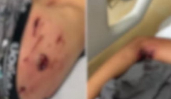 Pit bull ataca criança que tentava pegar pipa em Itumbiara, diz polícia