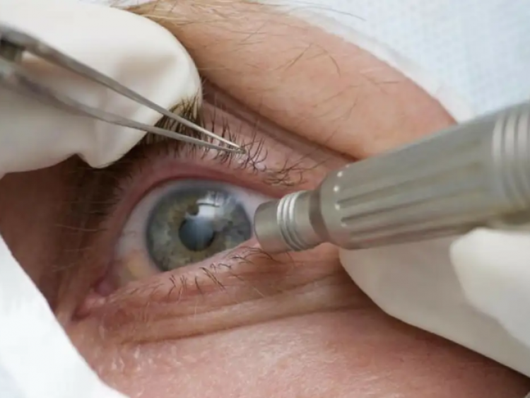 Cirurgia que muda cor dos olhos pode causar cegueira e não é estética segura, alerta conselho