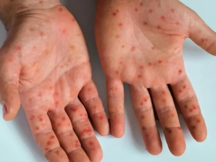 Goiás registra 15 notificações de Mpox em 2026, informa Secretaria de Saúde