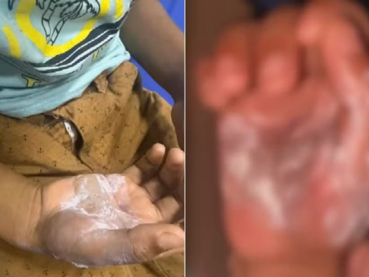 Mãe é presa suspeita de queimar filho de 7 anos com colher quente em Goiás
