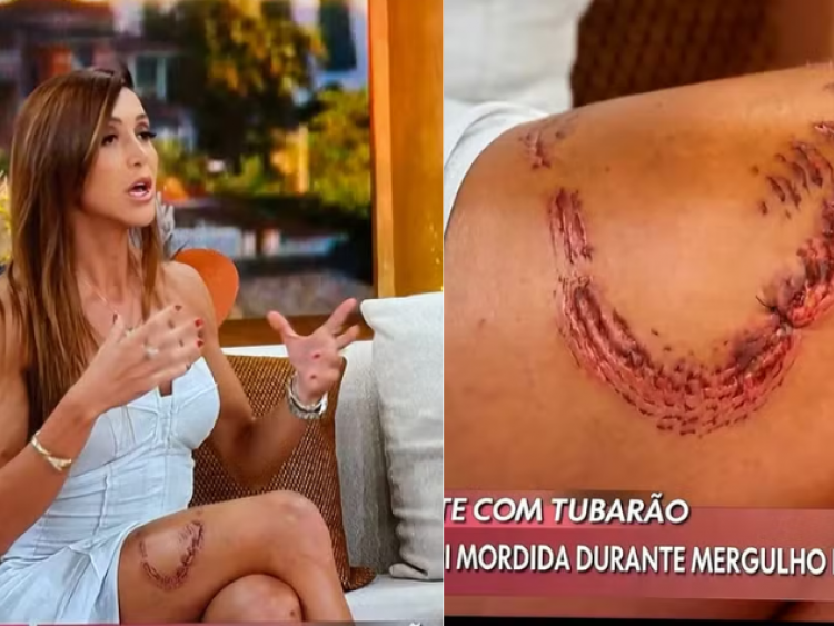Turista atacada por tubarão em Fernando de Noronha mostra marca da mordida